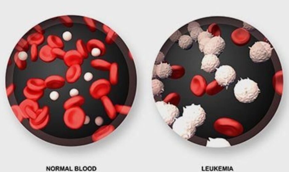 Leukaemia An Overview of Symptoms, Causes, Types & Treatment