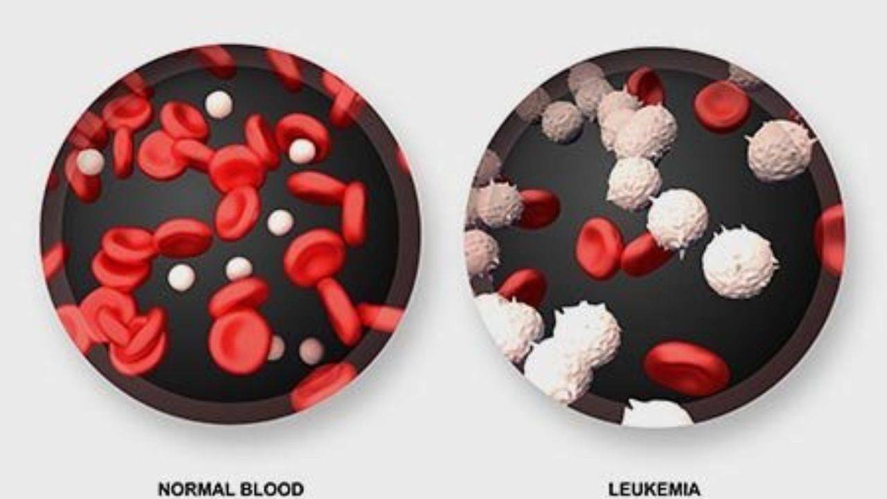 Leukaemia An Overview of Symptoms, Causes, Types & Treatment